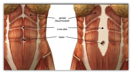 Linke Abbildung zeigt die Muskelbäuche aneinander und die rechte mit einer Rektusdiastase.